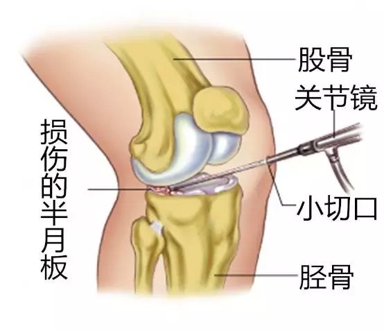 盘状半月板损伤的伤残评定标准与复治疗方案解析