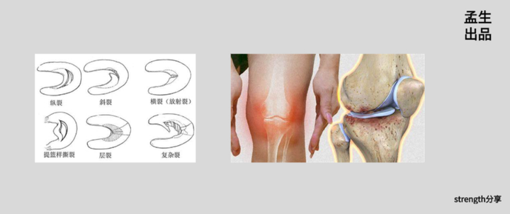 盘状半月板一辈子未受伤：不治疗后果、无需手术可能性、疼痛处理及自愈探讨