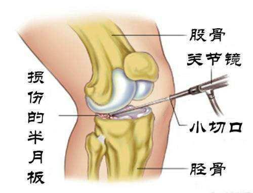 职工     ：盘状半月板撕裂未被认定为工伤