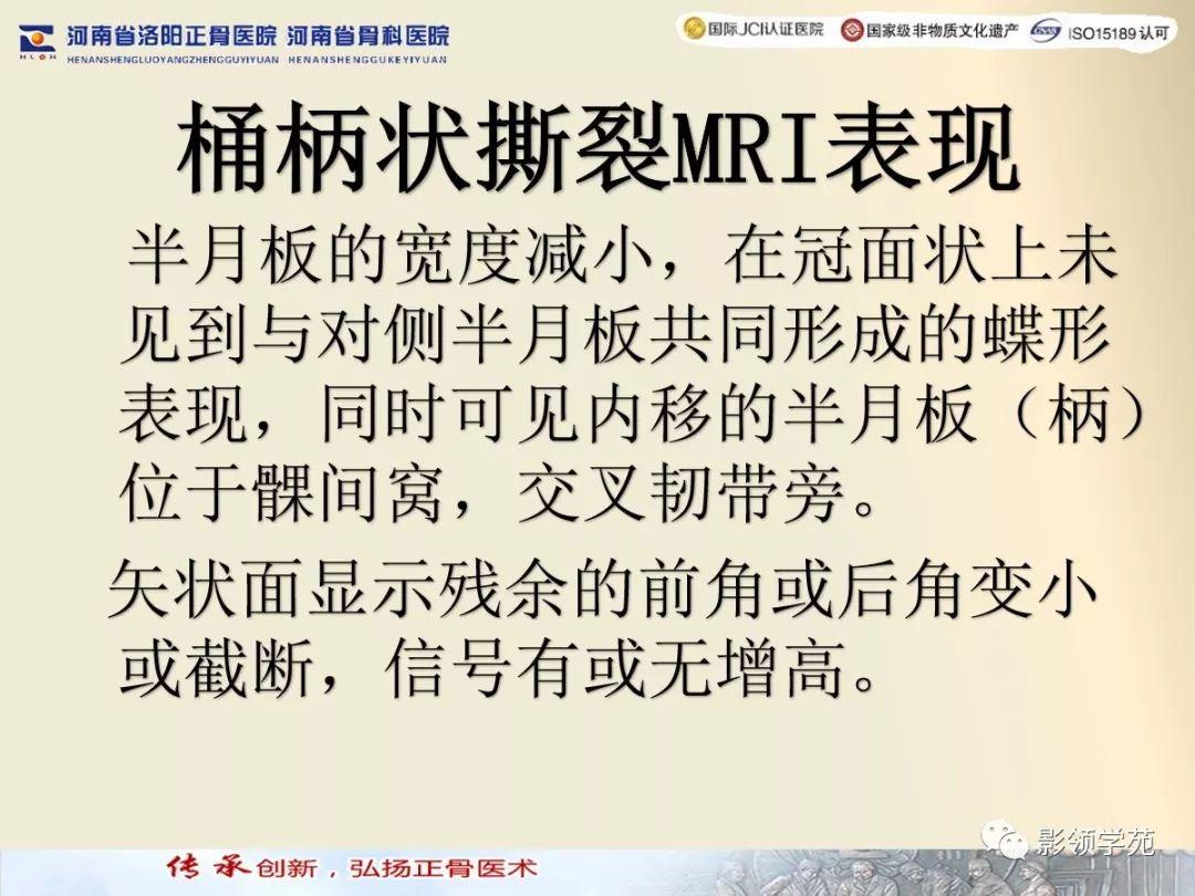 盘状半月板能鉴定伤残吗：损伤算工伤、手术必要性及摘除后评残标准解析