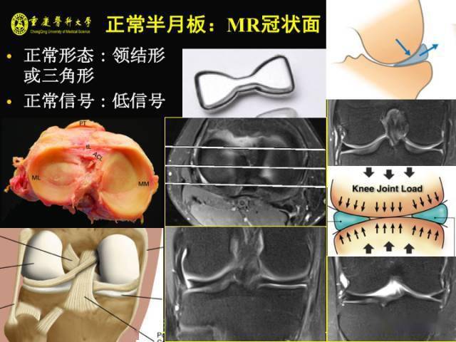 盘状半月板撕裂是否属于工伤：全面解析认定标准及处理流程