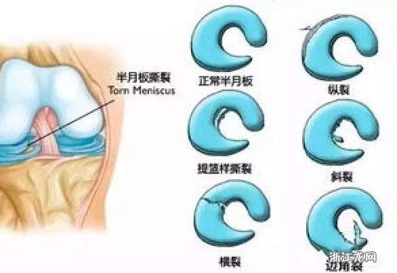 盘状半月板撕裂是否属于工伤：全面解析认定标准及处理流程