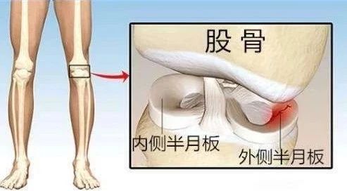 盘状半月板损伤能自愈吗：恢复时长、身影响、遗传因素及运动限制探讨