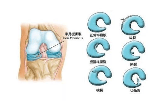 盘状半月板损伤能自愈吗：恢复时长、身影响、遗传因素及运动限制探讨