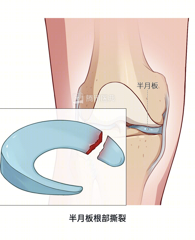 盘状半月板损伤能自愈吗：恢复时长、身影响、遗传因素及运动限制探讨