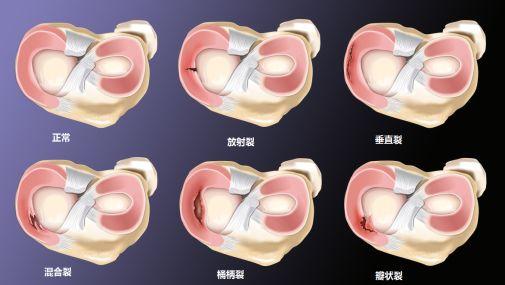 盘状半月板损伤能自愈吗：恢复时长、身影响、遗传因素及运动限制探讨