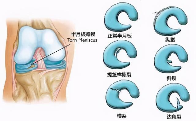 盘状半月板：先天结构缺陷使其更易遭受损伤风险