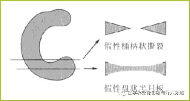 盘状半月板：先天结构缺陷使其更易遭受损伤风险