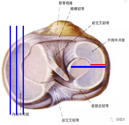 盘状半月板能认定工伤吗