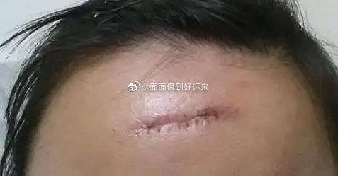 眉骨出血后的疤痕问题：是否会留下永久性痕迹？