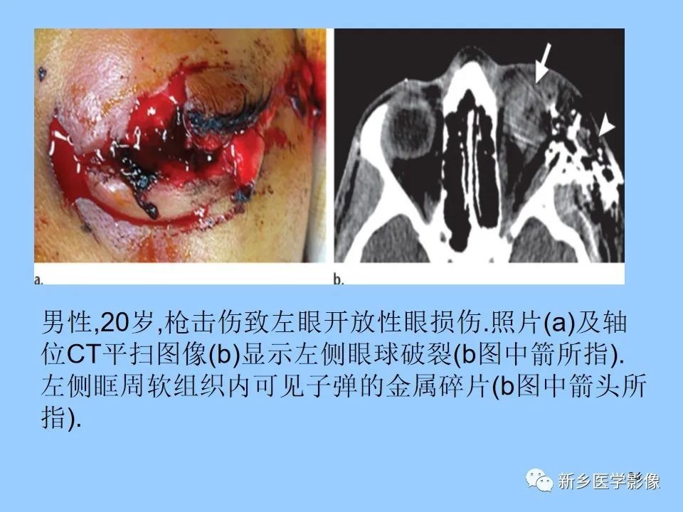 眼球破裂伤能认定工伤吗