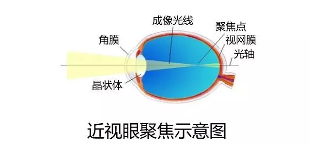 眼睛近视算不算工伤：事故范围、伤残认定及工伤性质探讨