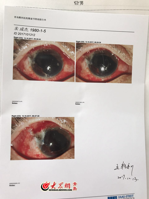 如何处理眼部异物的全面指南：铁屑进入眼睛的正确处理方法与急救措