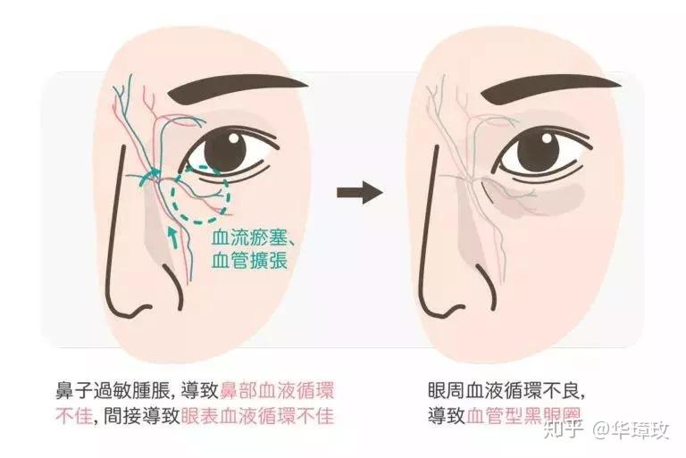 全面指南：眼部化学烧伤的急救措与后续处理方法