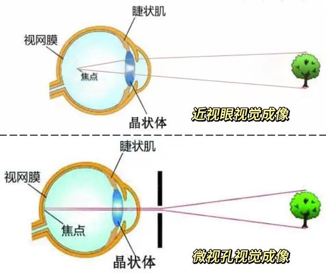 结合医学法医学视角：虹膜损伤与视力下降的眼部轻伤鉴定细则