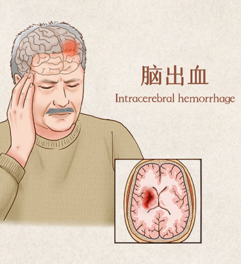 脑出血突发：是否被认定为重大疾病？