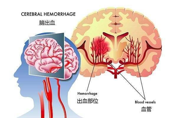 脑出血突发：是否被认定为重大疾病？