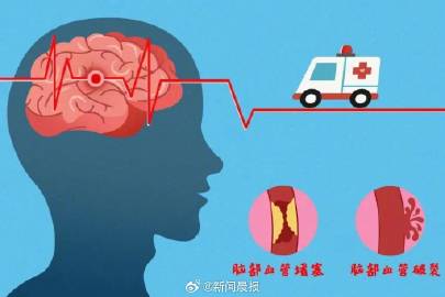 脑出血突发：是否被认定为重大疾病？