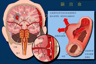 突发脑出血算不算重大疾病及是否属于意外保险范围