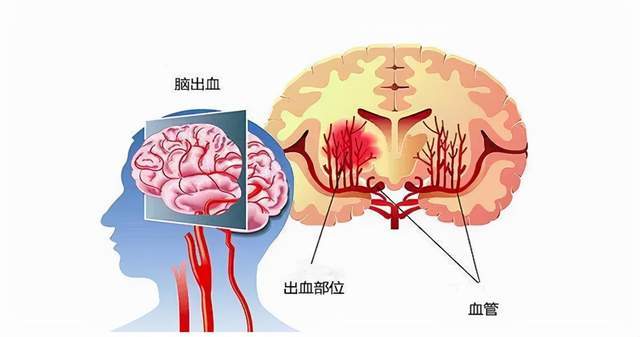 突发脑出血算不算重大疾病及是否属于意外保险范围