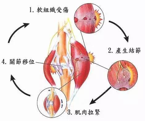 '肌肉纤维严重拉伤：筋撕裂紧急处理指南'