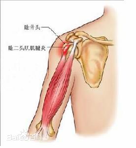 '肌肉纤维严重拉伤：筋撕裂紧急处理指南'