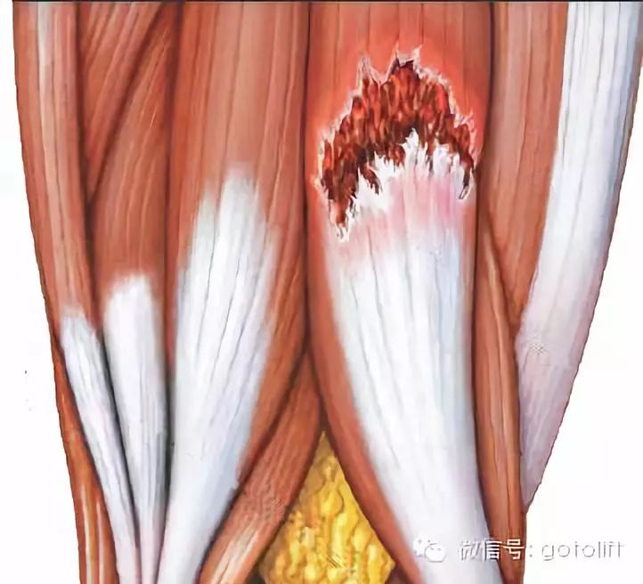 '肌肉纤维严重拉伤：筋撕裂紧急处理指南'