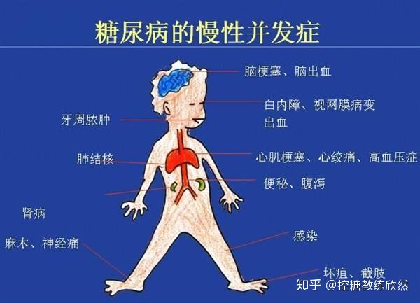 糖尿病截肢患者的生存期与生活质量：如何长寿命并提高生活品质