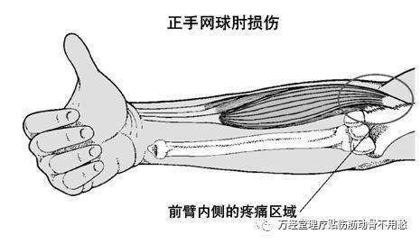 网球肘怎样认定工伤