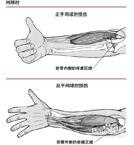 网球肘怎样认定工伤