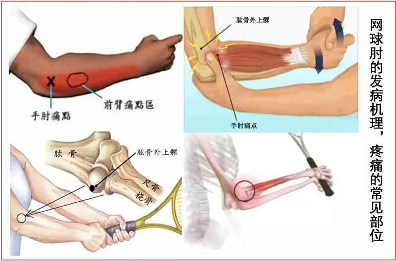 网球肘怎样认定工伤