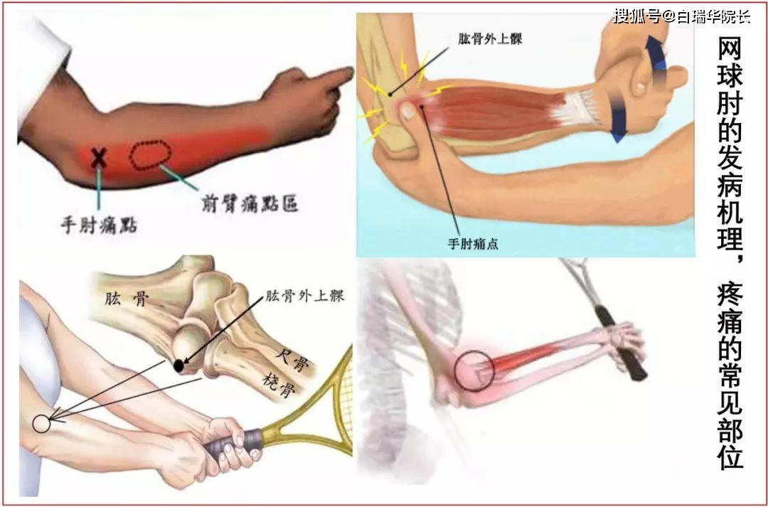 网球肘炎是否可达工伤认定及其伤残等级评估探讨