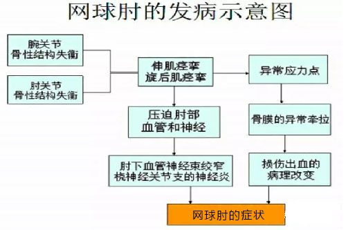 网球肘炎是否可达工伤认定及其伤残等级评估探讨