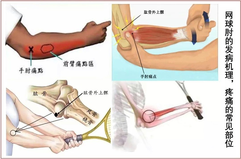 网球肘能否被认定为工伤：申请条件、流程及常见疑问解答