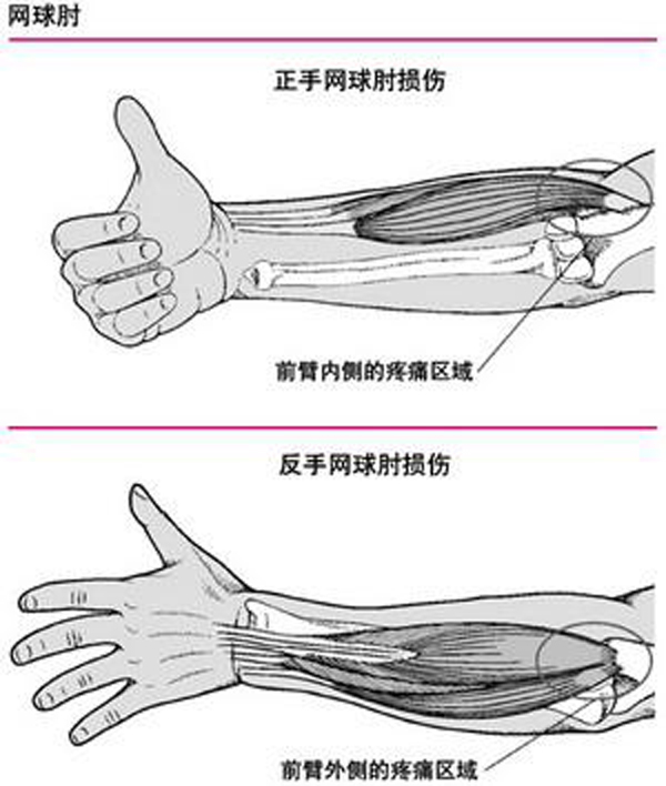 网球肘患者能否享受病退待遇：探讨肱骨外上髁炎的职业影响