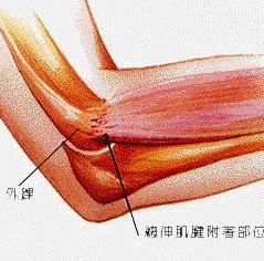 网球肘炎能认定工伤