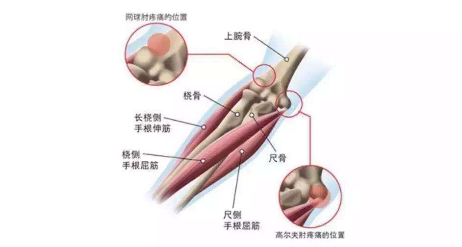 网球肘职业病认定：它能否被归类为工伤？