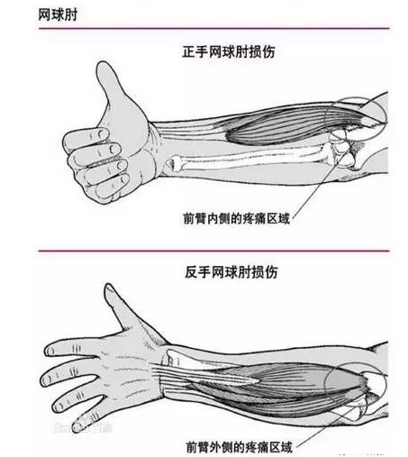 网球肘病假时长指南：如何合理申请及恢复期注意事项