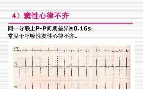 体检报告array：解读含义、多久出结果、性心律意义及三项指标查询方法