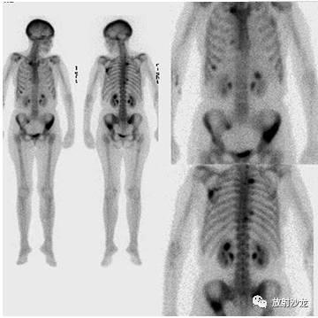 ai医学影像骨折分析报告模板：骨折医学影像学描述与报告撰写范例