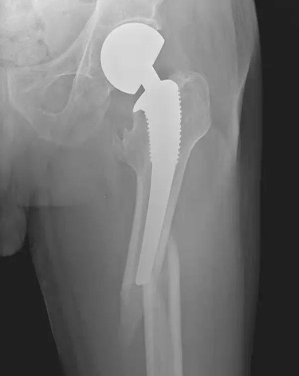 ai医学影像骨折分析报告模板：骨折医学影像学描述与报告撰写范例