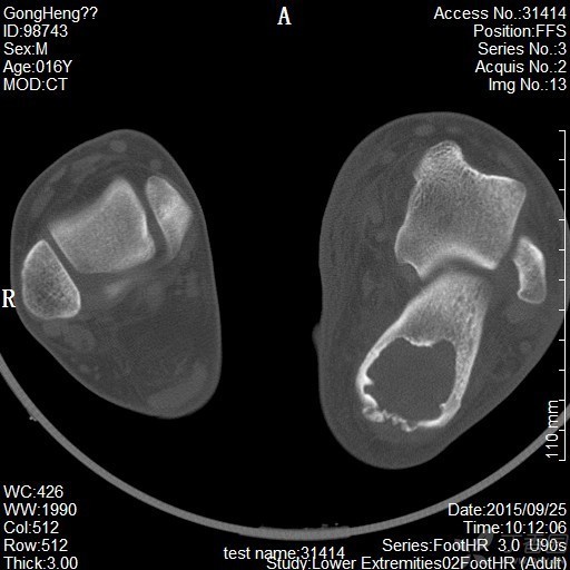 骨折医学影像诊断与评估：全面解析X光、CT、MRI在骨折诊断中的应用