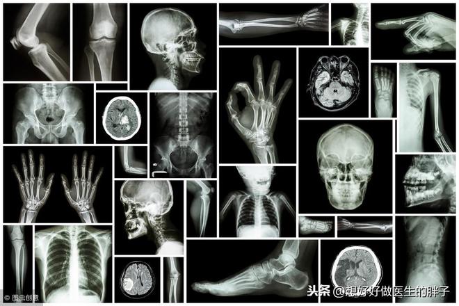 骨折医学影像诊断与评估：全面解析X光、CT、MRI在骨折诊断中的应用