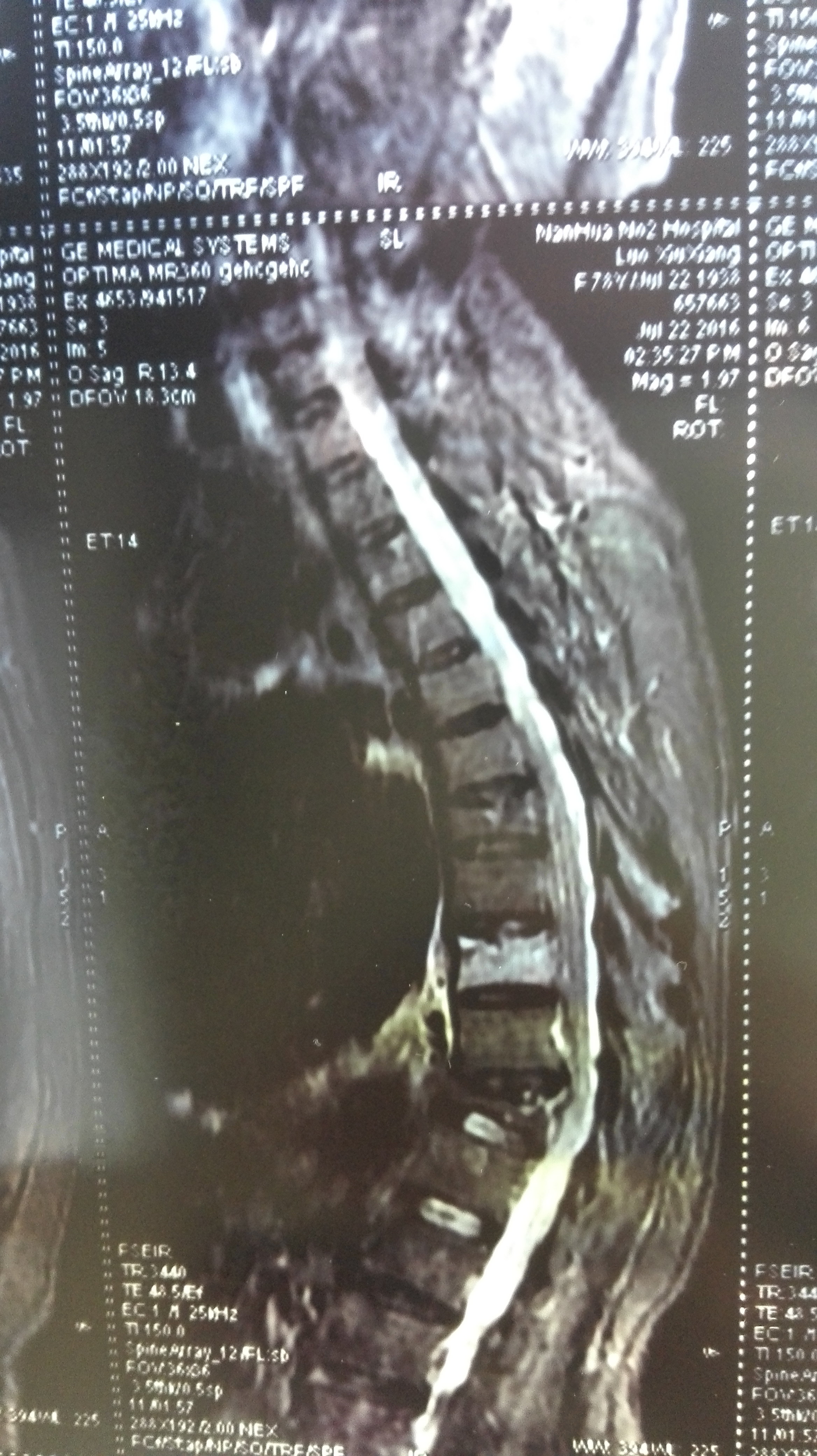 骨折医学影像诊断与评估：全面解析X光、CT、MRI在骨折诊断中的应用