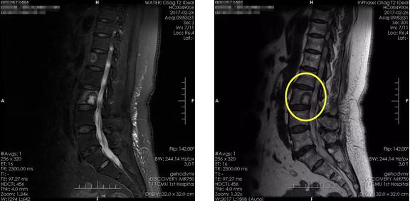 骨折医学影像诊断与评估：全面解析X光、CT、MRI在骨折诊断中的应用