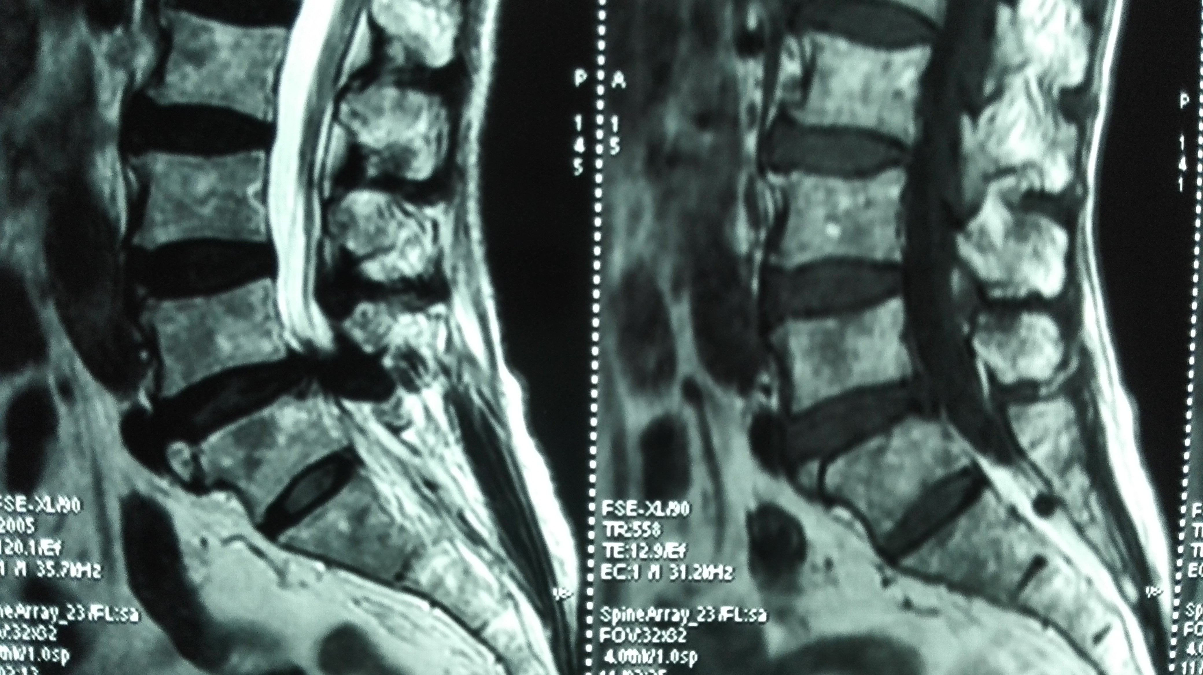 骨折医学影像诊断与评估：全面解析X光、CT、MRI在骨折诊断中的应用