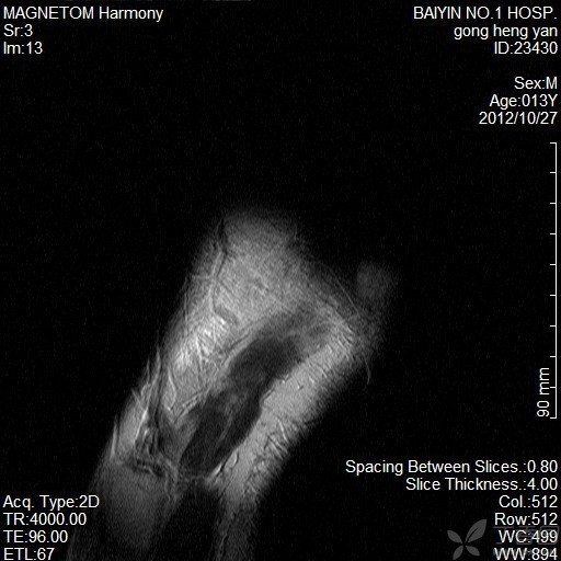 骨折医学影像诊断与评估：全面解析X光、CT、MRI在骨折诊断中的应用