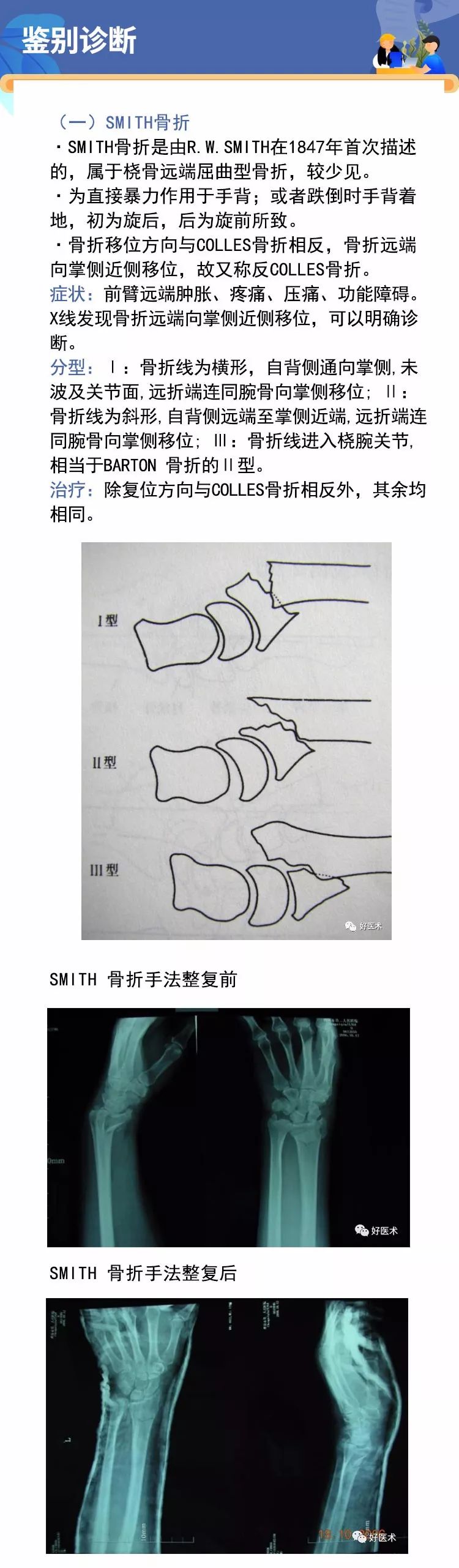 Colles骨折影像学报告：诊断描述与报告撰写