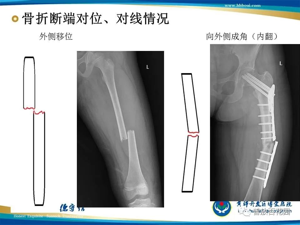 骨折诊断的影像学技术与进展解析