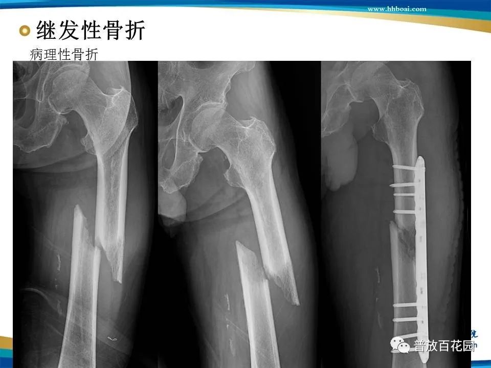 骨折诊断的影像学技术与进展解析